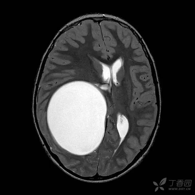 【病例】脑内囊性包虫病1例CT及MR 【病例】脑内囊性包虫病1例CT及MR