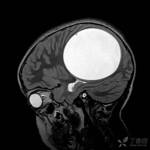 【病例】脑内囊性包虫病1例CT及MR 【病例】脑内囊性包虫病1例CT及MR