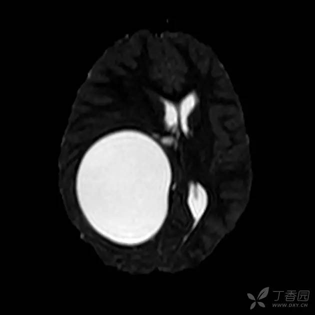 【病例】脑内囊性包虫病1例CT及MR 【病例】脑内囊性包虫病1例CT及MR