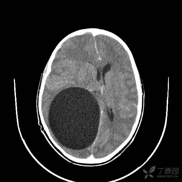 【病例】脑内囊性包虫病1例CT及MR 【病例】脑内囊性包虫病1例CT及MR