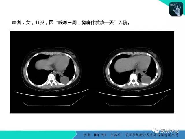 【病例】肺脓肿1例CT影像诊断与鉴别
