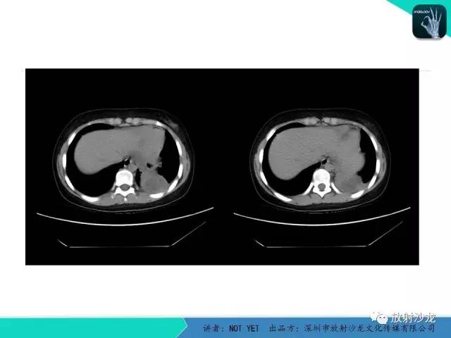 【病例】肺脓肿1例CT影像诊断与鉴别