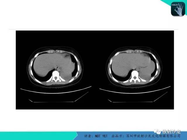 【病例】肺脓肿1例CT影像诊断与鉴别