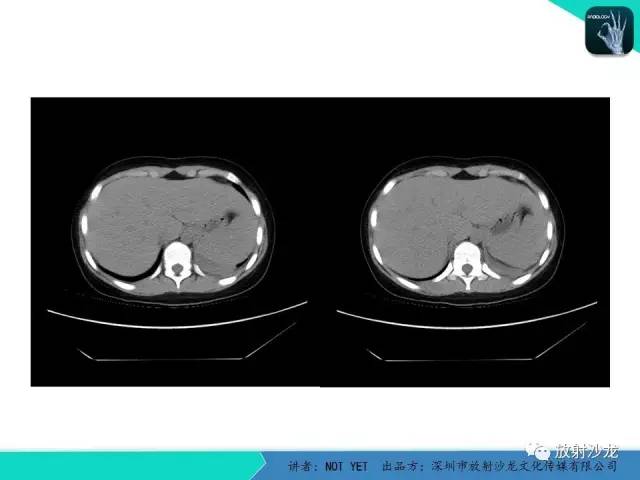 【病例】肺脓肿1例CT影像诊断与鉴别