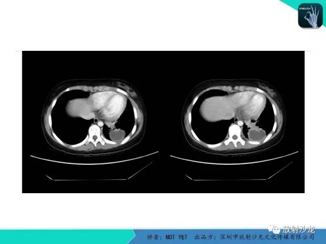 【病例】肺脓肿1例CT影像诊断与鉴别