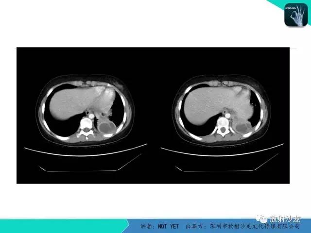 【病例】肺脓肿1例CT影像诊断与鉴别