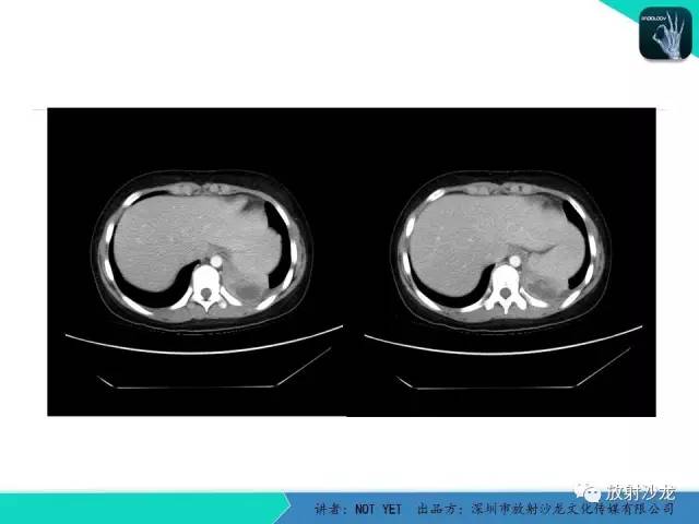 【病例】肺脓肿1例CT影像诊断与鉴别