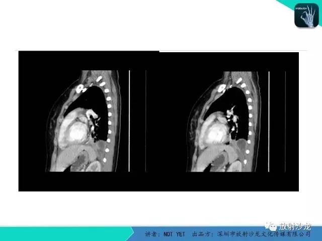 【病例】肺脓肿1例CT影像诊断与鉴别