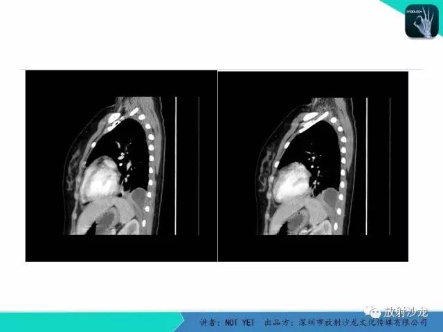 【病例】肺脓肿1例CT影像诊断与鉴别