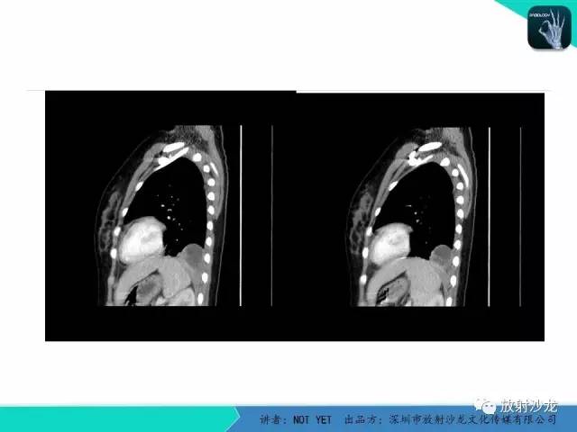 【病例】肺脓肿1例CT影像诊断与鉴别