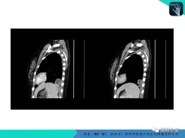 【病例】肺脓肿1例CT影像诊断与鉴别