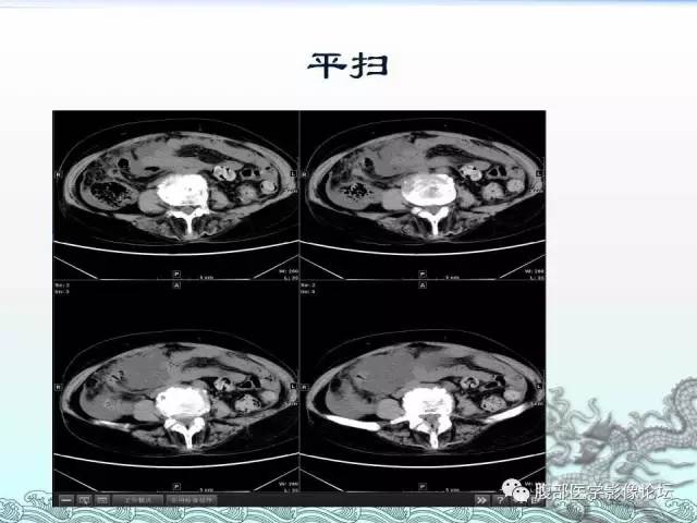 【病例】阑尾黏液囊腺癌1例CT影像表现