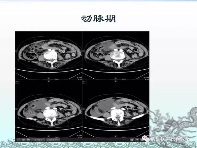 【病例】阑尾黏液囊腺癌1例CT影像表现