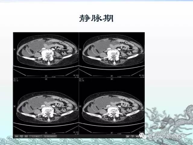 【病例】阑尾黏液囊腺癌1例CT影像表现