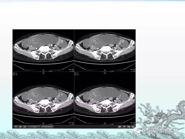 【病例】阑尾黏液囊腺癌1例CT影像表现