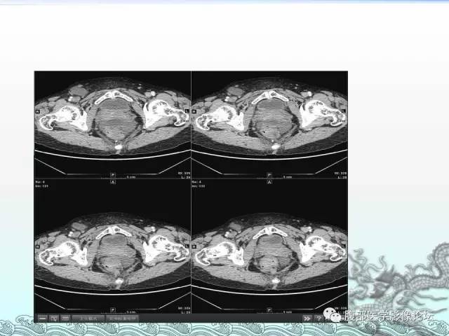 【病例】阑尾黏液囊腺癌1例CT影像表现