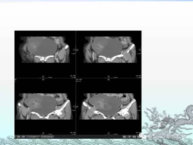 【病例】阑尾黏液囊腺癌1例CT影像表现