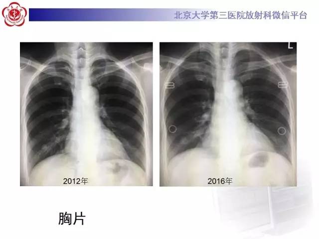 【病例】硬化性肺泡细胞瘤/肺硬化性血管瘤1例CT