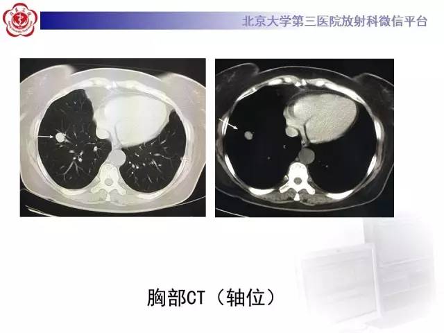 【病例】硬化性肺泡细胞瘤/肺硬化性血管瘤1例CT