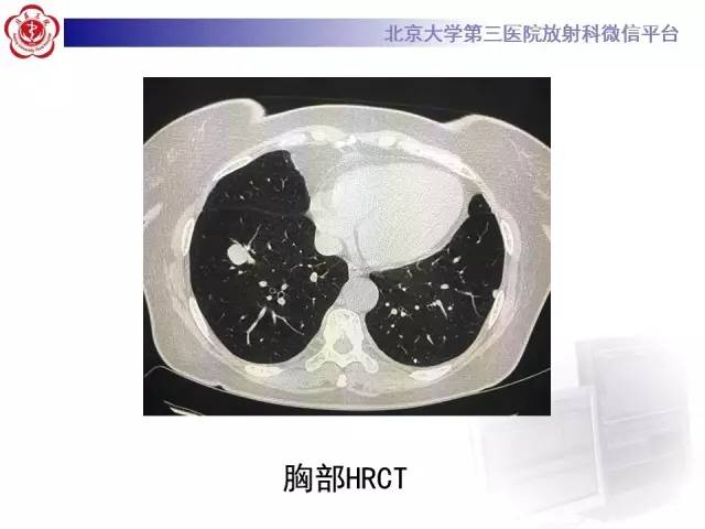【病例】硬化性肺泡细胞瘤/肺硬化性血管瘤1例CT