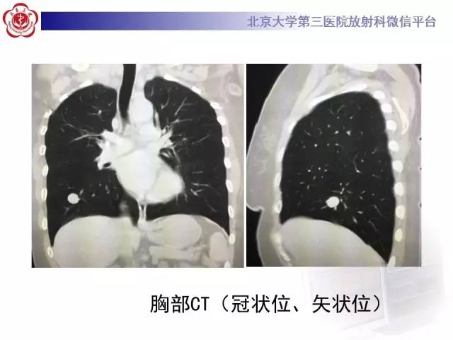 【病例】硬化性肺泡细胞瘤/肺硬化性血管瘤1例CT