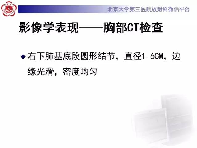 【病例】硬化性肺泡细胞瘤/肺硬化性血管瘤1例CT