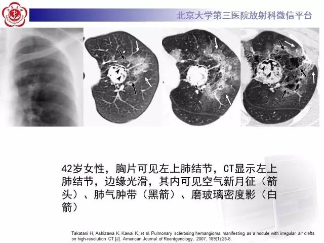 【病例】硬化性肺泡细胞瘤/肺硬化性血管瘤1例CT