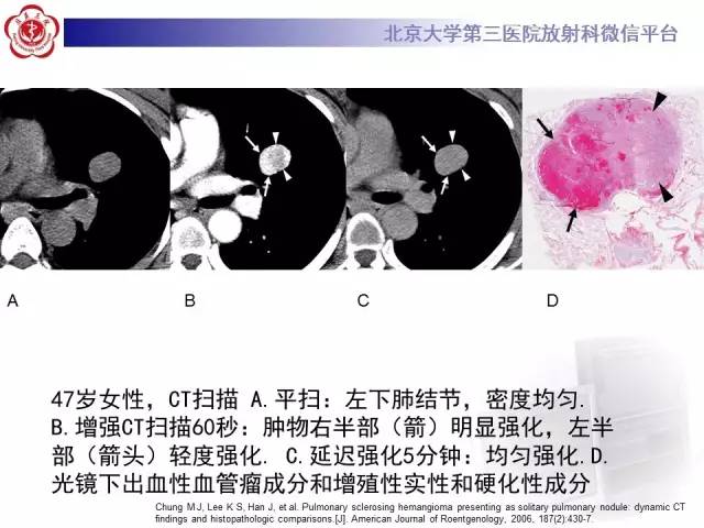 【病例】硬化性肺泡细胞瘤/肺硬化性血管瘤1例CT