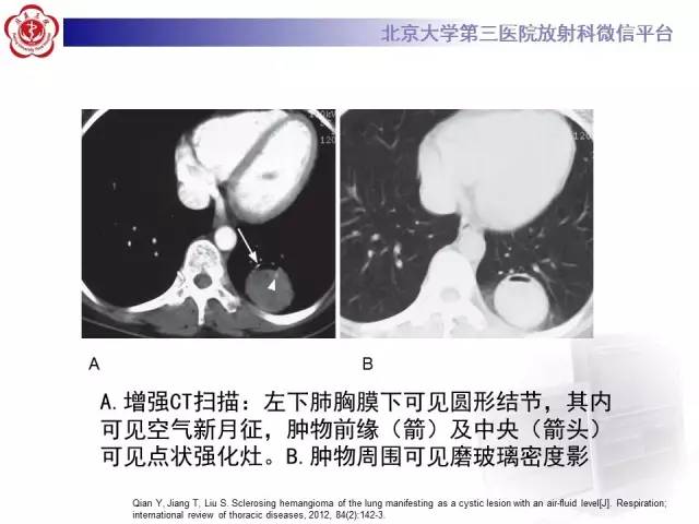 【病例】硬化性肺泡细胞瘤/肺硬化性血管瘤1例CT