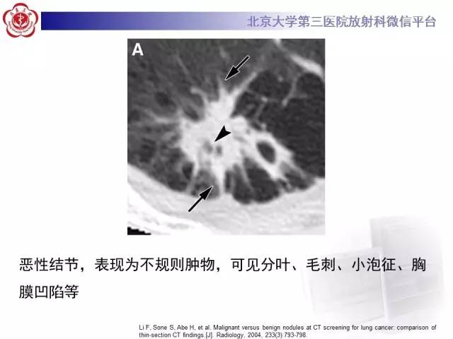 【病例】硬化性肺泡细胞瘤/肺硬化性血管瘤1例CT