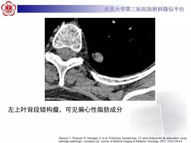 【病例】硬化性肺泡细胞瘤/肺硬化性血管瘤1例CT
