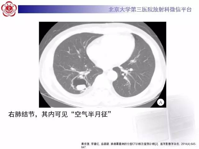 【病例】硬化性肺泡细胞瘤/肺硬化性血管瘤1例CT
