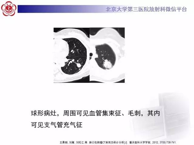 【病例】硬化性肺泡细胞瘤/肺硬化性血管瘤1例CT