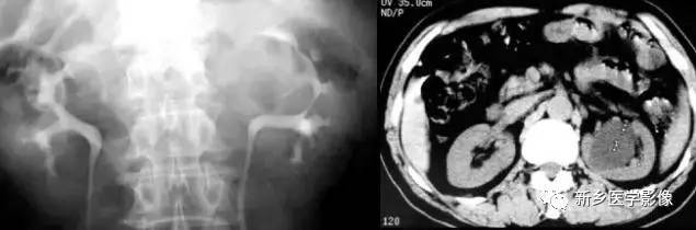 肾脏的13种囊性病变及诊断思路 肾脏的13种囊性病变及诊断思路