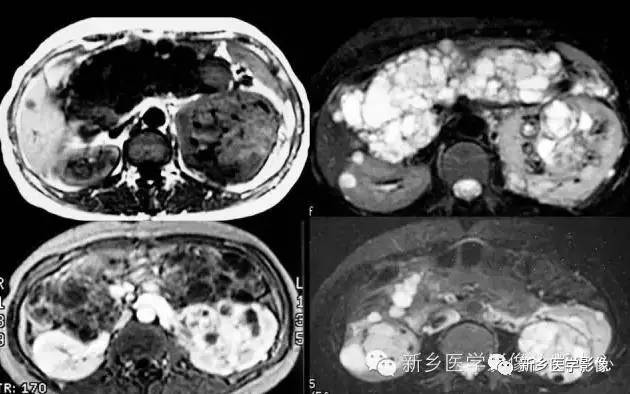 肾脏的13种囊性病变及诊断思路 肾脏的13种囊性病变及诊断思路