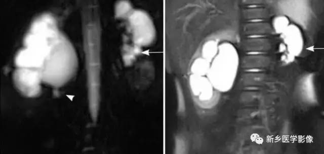 肾脏的13种囊性病变及诊断思路 肾脏的13种囊性病变及诊断思路