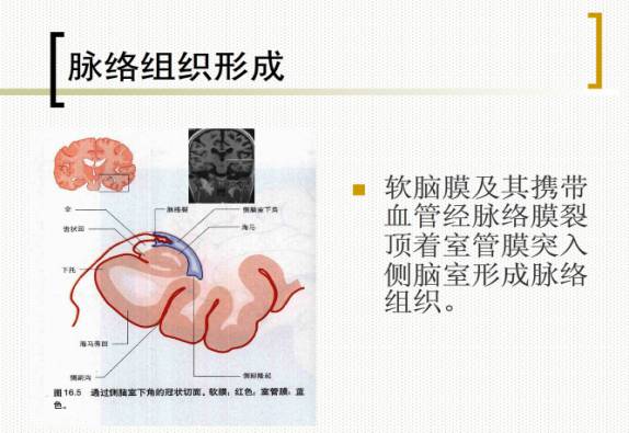 脉络膜裂囊肿