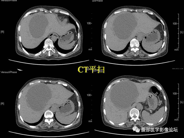 【病例】肝内胆管内乳头状粘液肿瘤1例CT