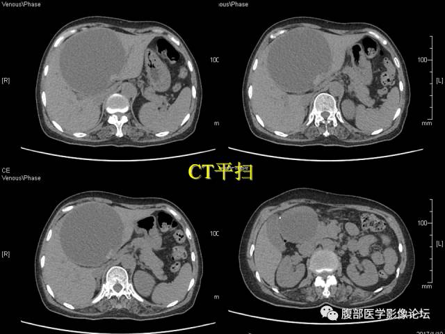 【病例】肝内胆管内乳头状粘液肿瘤1例CT