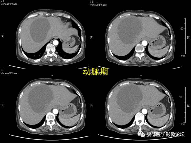 【病例】肝内胆管内乳头状粘液肿瘤1例CT