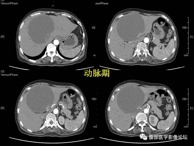 【病例】肝内胆管内乳头状粘液肿瘤1例CT