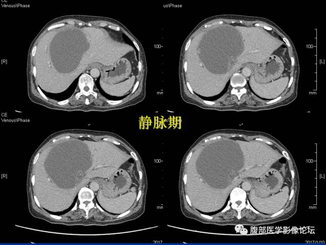 【病例】肝内胆管内乳头状粘液肿瘤1例CT