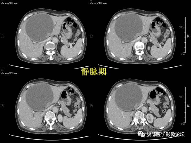 【病例】肝内胆管内乳头状粘液肿瘤1例CT