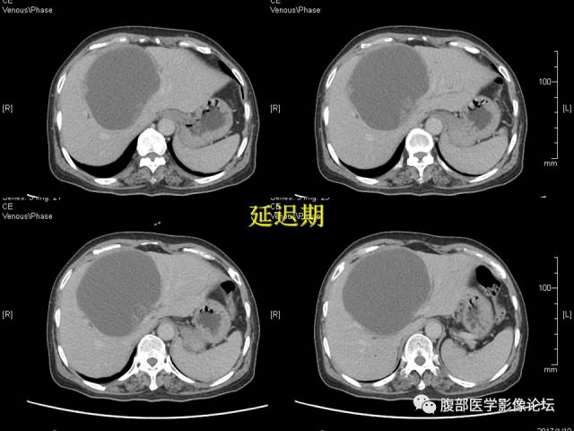 【病例】肝内胆管内乳头状粘液肿瘤1例CT