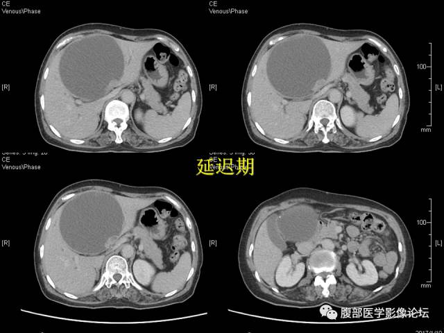 【病例】肝内胆管内乳头状粘液肿瘤1例CT