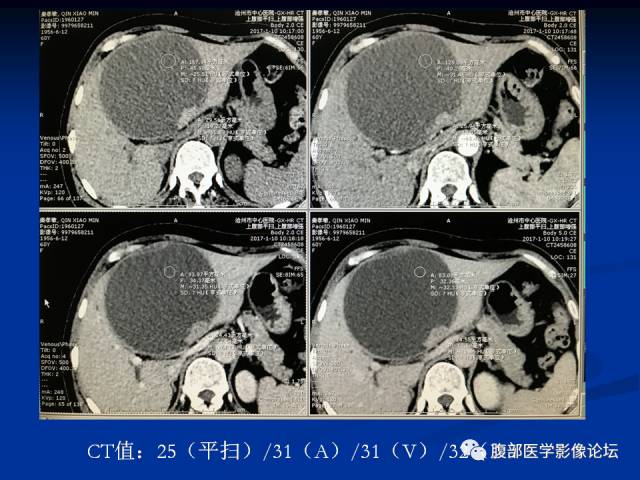 【病例】肝内胆管内乳头状粘液肿瘤1例CT