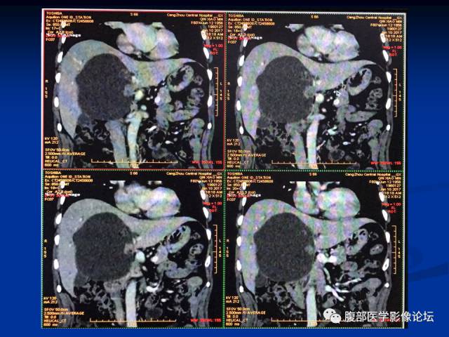【病例】肝内胆管内乳头状粘液肿瘤1例CT