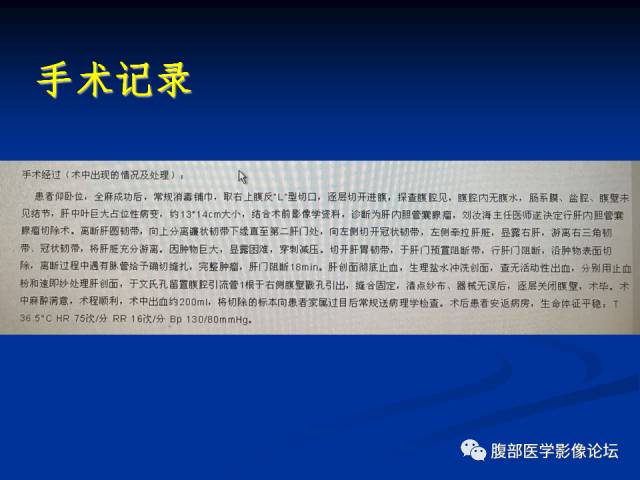 【病例】肝内胆管内乳头状粘液肿瘤1例CT