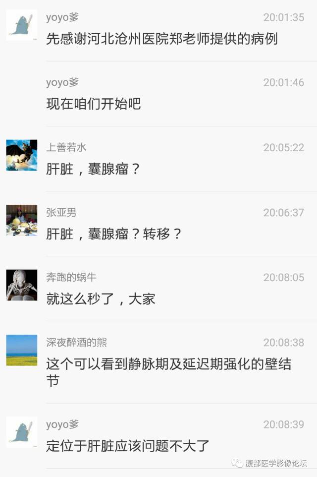 【病例】肝内胆管内乳头状粘液肿瘤1例CT
