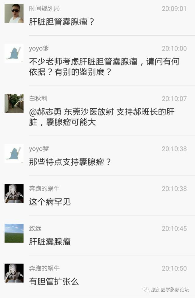 【病例】肝内胆管内乳头状粘液肿瘤1例CT
